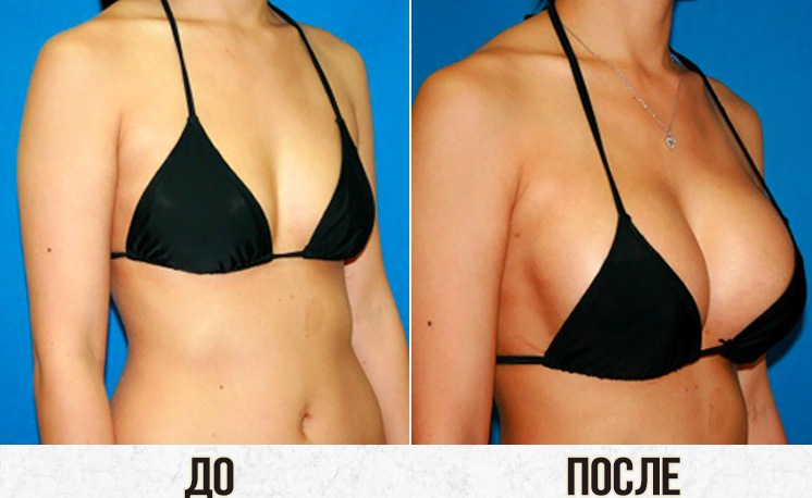 Липофилинг груди в Минске. Консультации по цене. Фото до и после