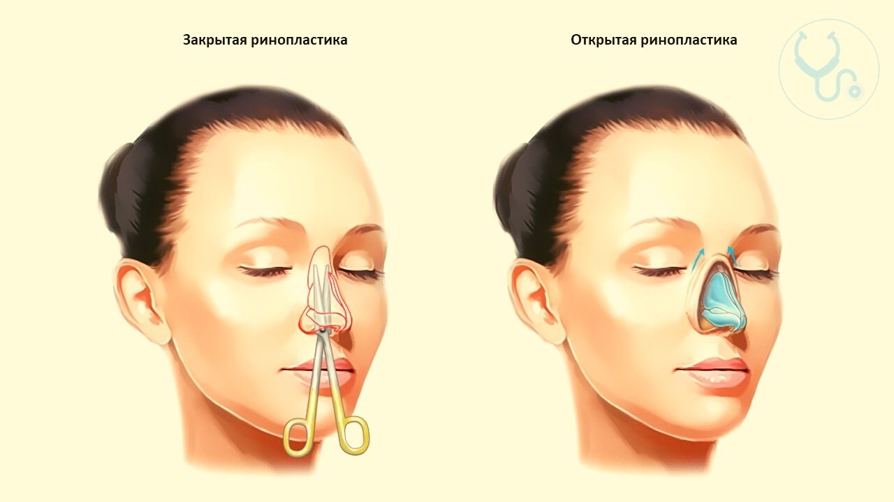 Как проходит ринопластика - клиника Золотое Сечение